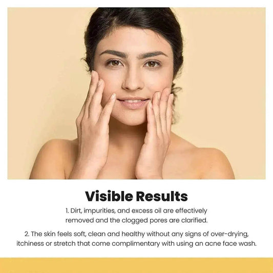 Acne Check Face Wash 100g – Clear & Oil-Free Skin